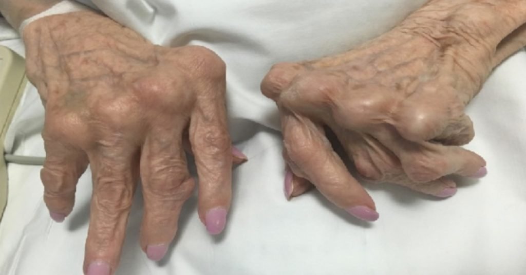 Arthritis: Causes, Symptoms, and Ayurvedic Treatment for Joint Pain Relief