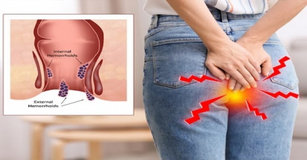 Piles (Hemorrhoids): Causes, Symptoms, Treatment, and Prevention