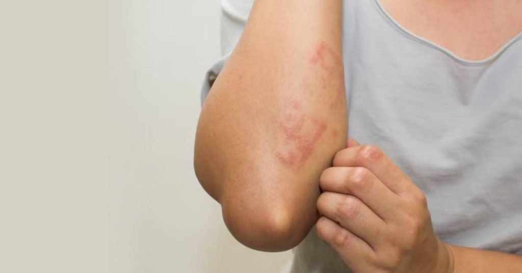 🌸 What is Skin Allergy