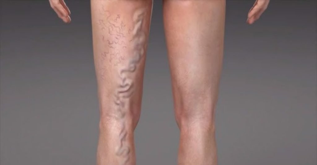 Causes of Varicose Veins