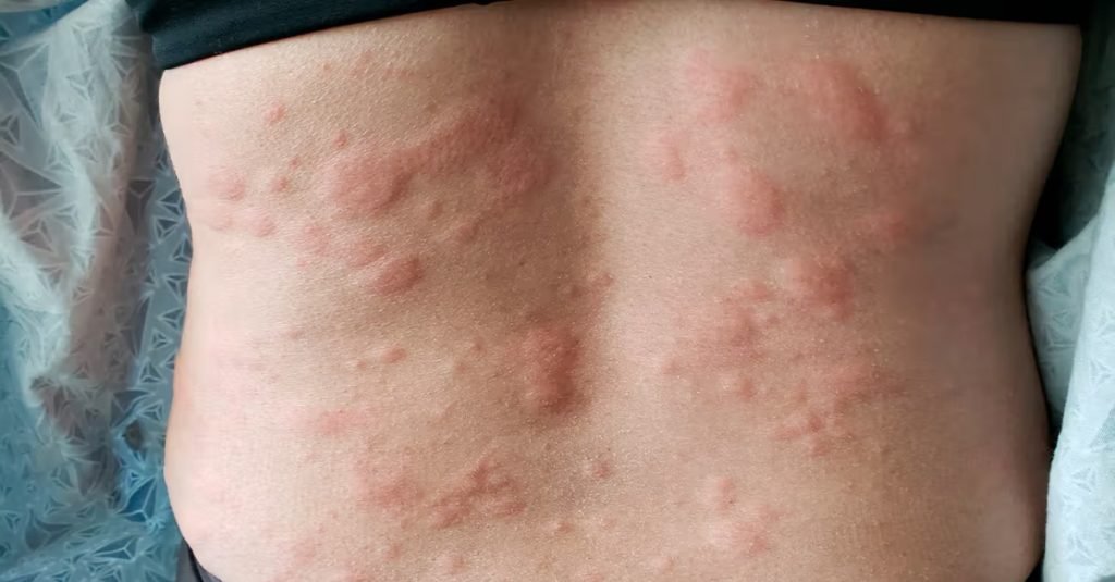 🌺 Symptoms of Skin Allergy