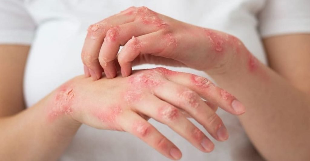Skin Allergy Causes, Symptoms, and Best Ayurvedic Treatment