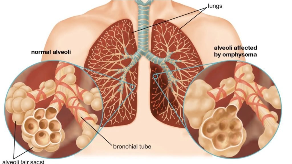 🧘‍♂️ Pranayama and Yoga for Respiratory Wellness