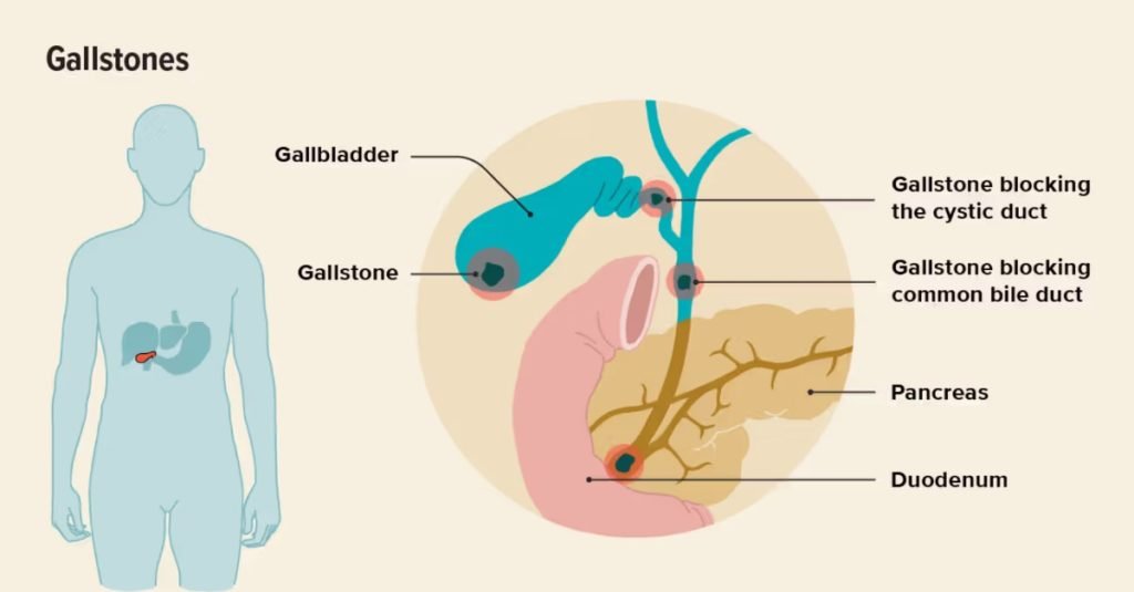 Complications of Untreated Gallstones