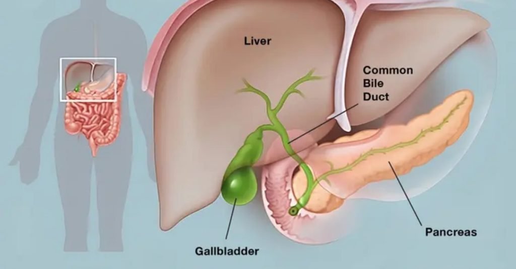 Treatment of Gallbladder Stone: