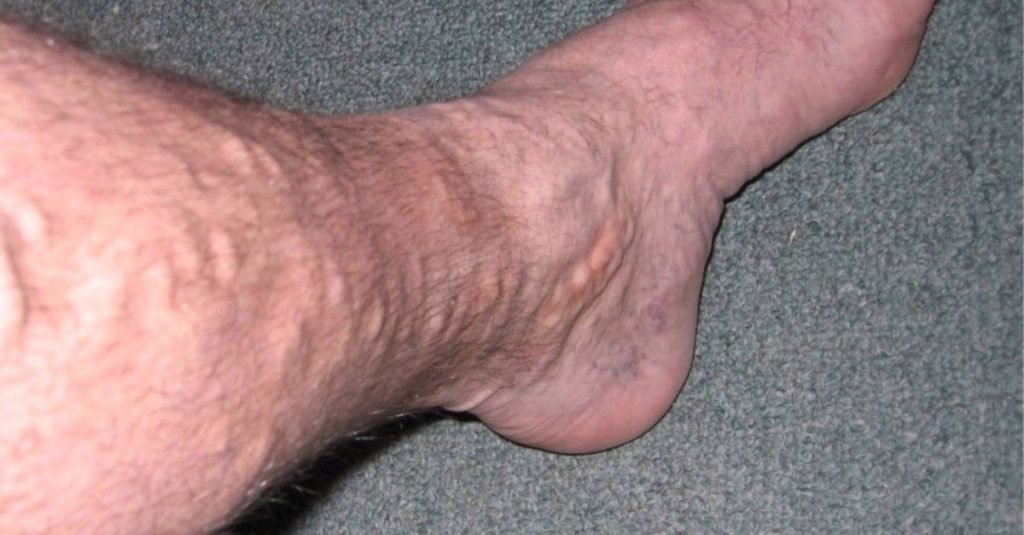 🌿 Ayurvedic Treatment for Varicose Veins