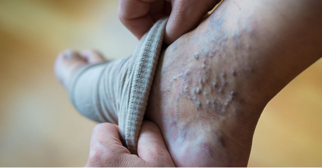 🩺 Varicose Veins in Ayurveda – Understanding the Root Cause