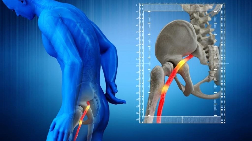 Causes of Sciatica Pain