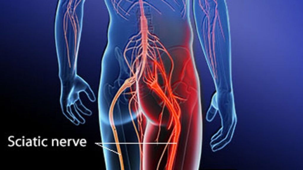 Sciatica Pain Causes, Symptoms & Ayurvedic Management
