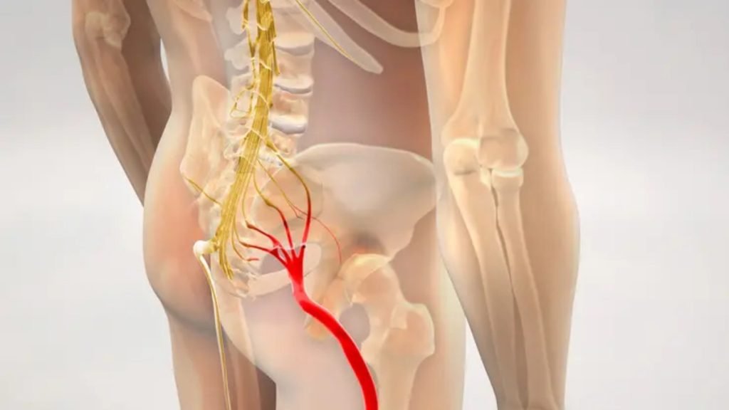 What is Sciatica Pain