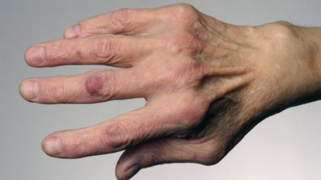 गठिया में गाँठ बनने की प्रमुख वजहें (Main Reasons Behind Nodules in Arthritis)
