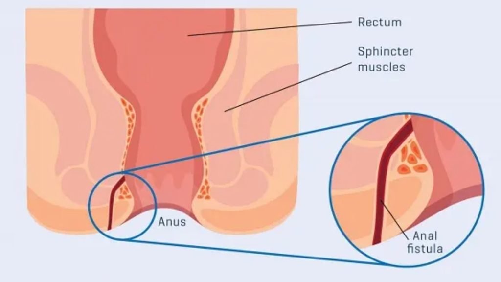 फिस्टुला क्या होता है?