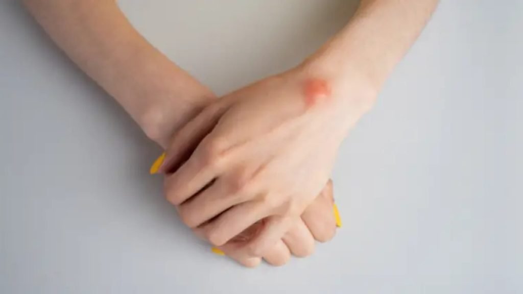 लाइपोमा क्या है (What is Lipoma)