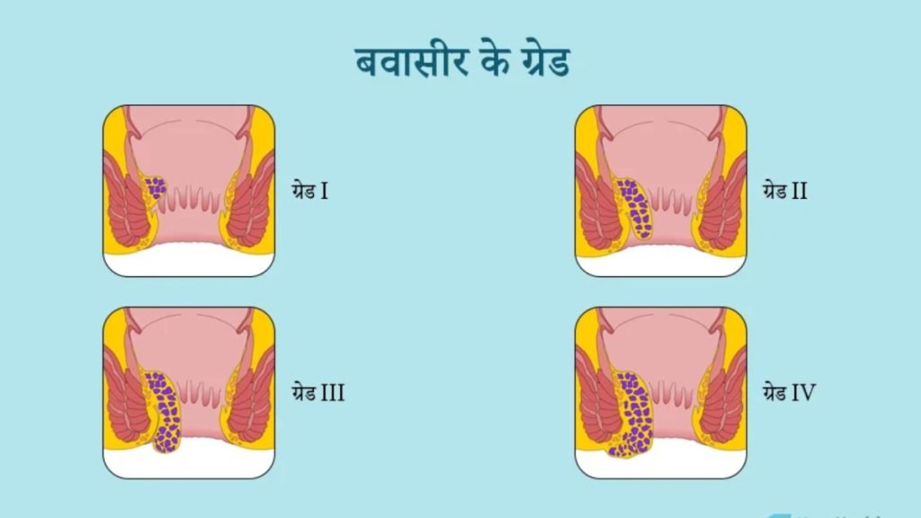 Grade 4 Piles क्या होती है