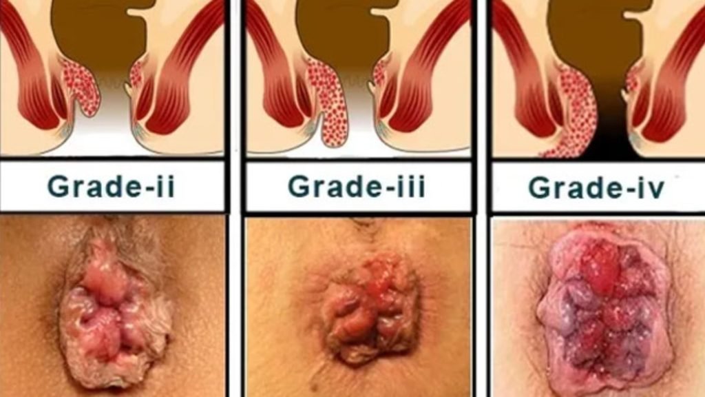 Grade 4 की Piles क्या आयुर्वेद में ठीक हो सकती है Jeevan Ayurveda