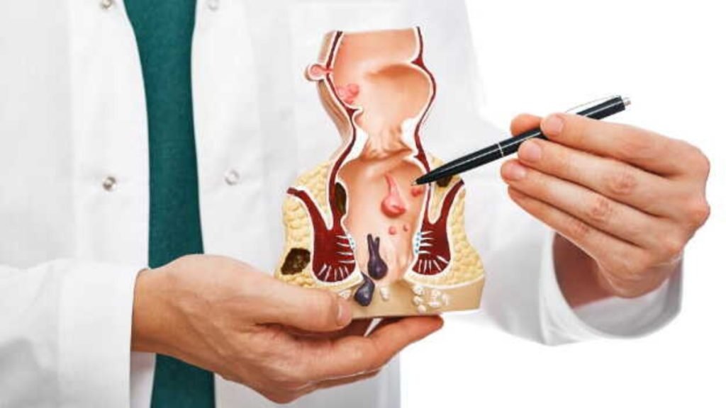 Jeevan Ayurveda में Grade 4 Piles का आयुर्वेदिक इलाज