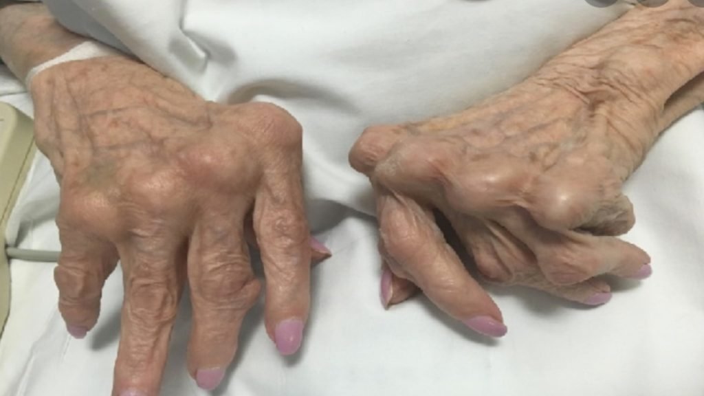 Rheumatoid Arthritis का मुख्य कारण क्या है