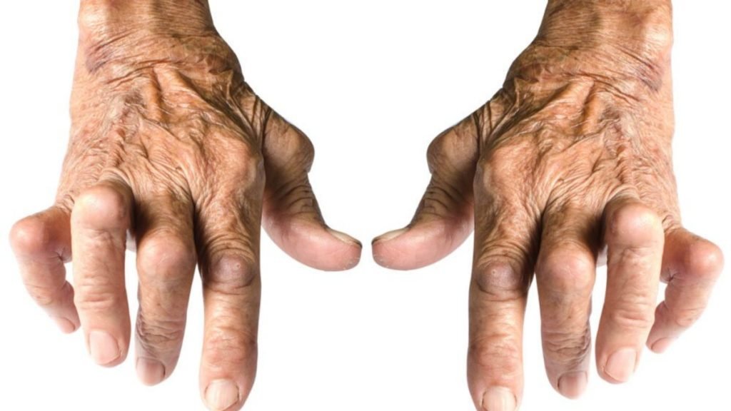 Rheumatoid Arthritis का मुख्य कारण क्या है – Jeevan Ayurveda