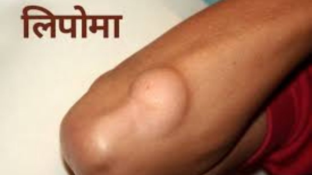 किन लोगों को Lipoma ज्यादा होता है
