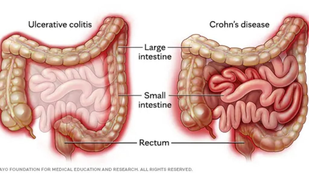 कोलाइटिस क्या है (What is Colitis)