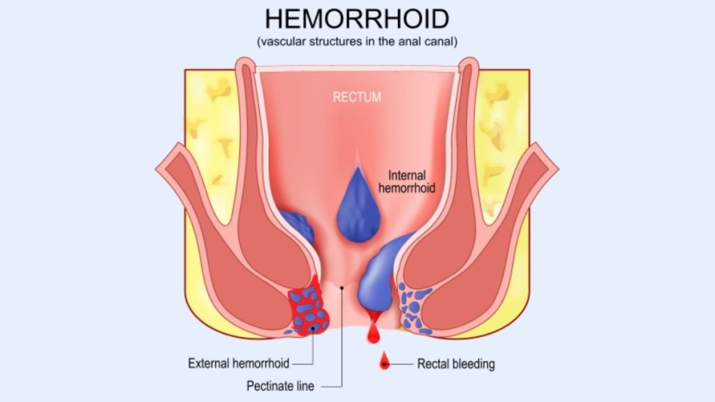 क्या Grade 4 की बवासीर आयुर्वेद में ठीक हो सकती है