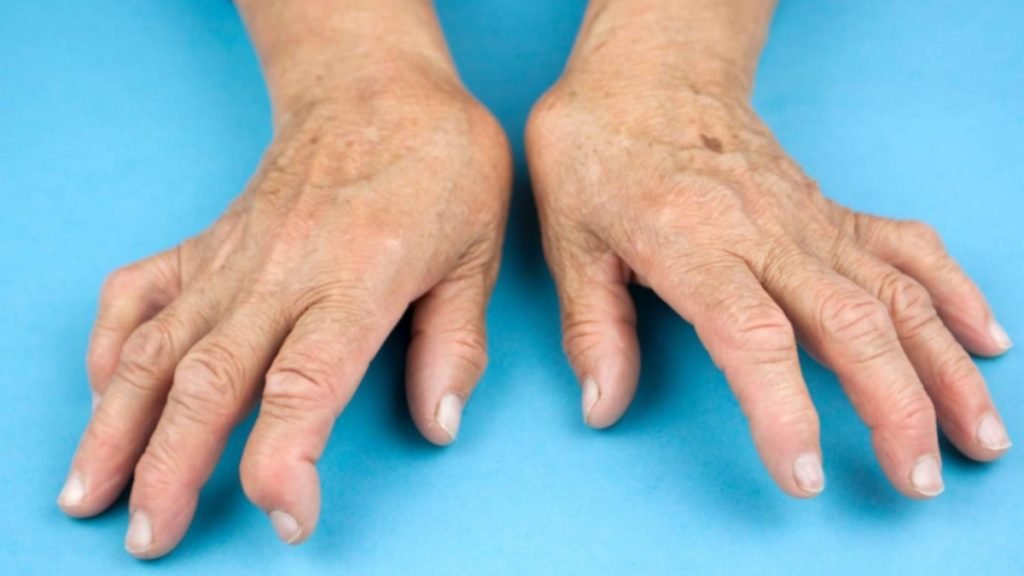 गठिया में गाँठ क्यों बन जाती है - Jeevan Ayurveda