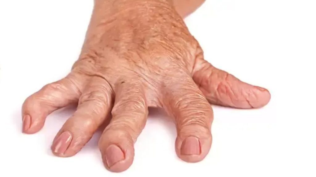 गाठिया (Rheumatoid Arthritis) क्या है