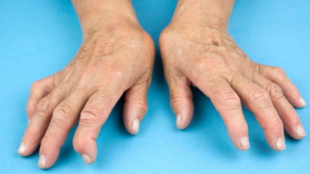 गाठिया में बुखार क्यों आता है (मुख्य कारण)