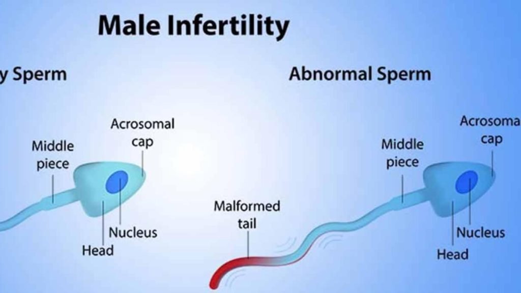 पुरुष बांझपन क्या होता है