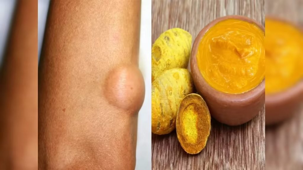 लाइपोमा में घरेलू और आयुर्वेदिक उपाय