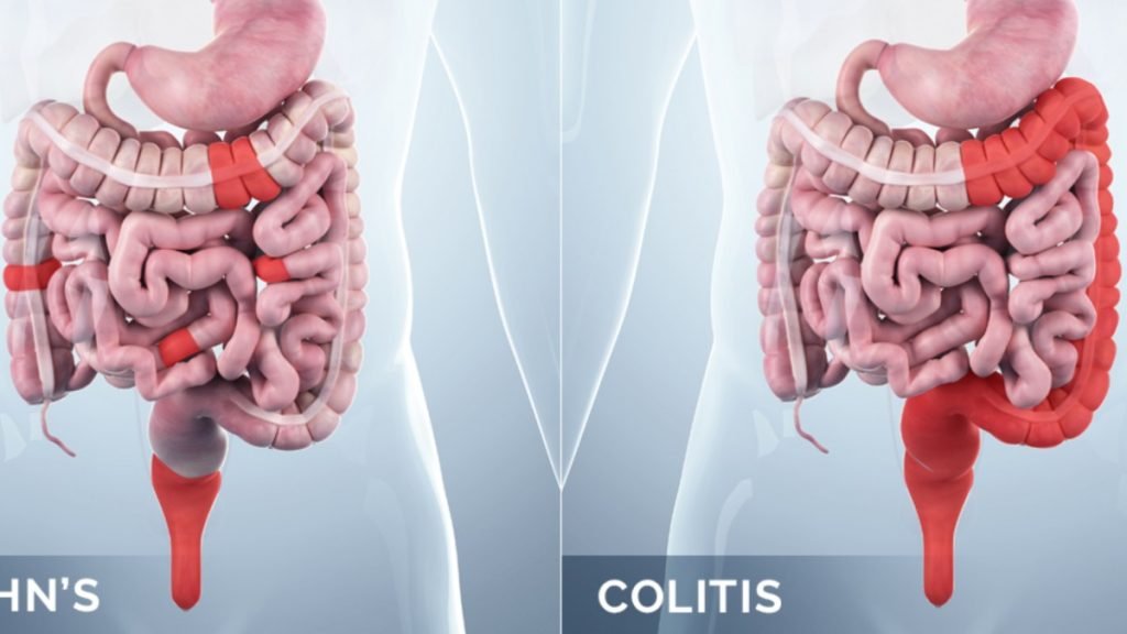 ⭐ कोलाइटिस का सबसे अच्छा इलाज — आयुर्वेद (Best Ayurvedic Treatment for Colitis)