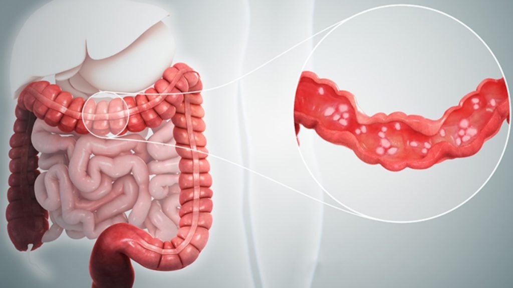 🌿 आयुर्वेद में कोलाइटिस का इलाज सबसे अच्छा क्यों माना जाता है