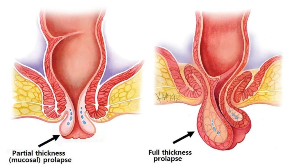 गुदा बाहर आने की समस्या क्या है (What is Rectal Prolapse)