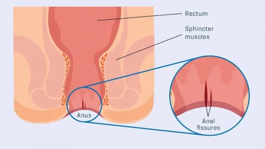 Anal Fissure क्या है