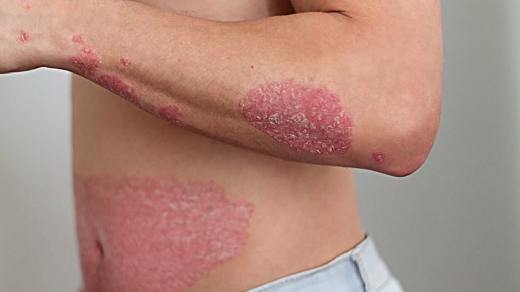 Psoriasis क्यों होता है 