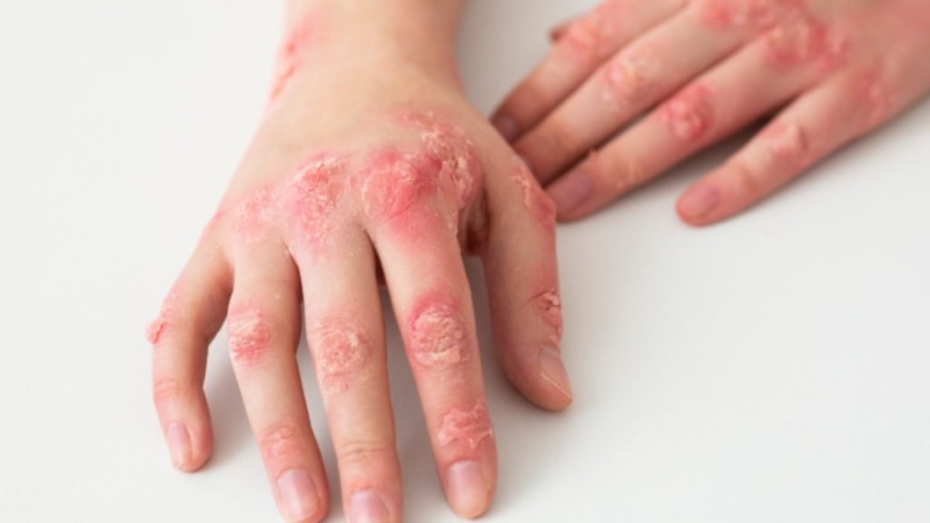 Psoriasis क्यों होता है क्या आयुर्वेद से सोरायसिस ठीक किया जा सकता है