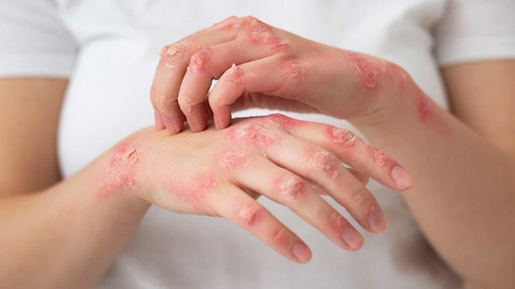 Psoriasis (सोरायसिस) क्या है