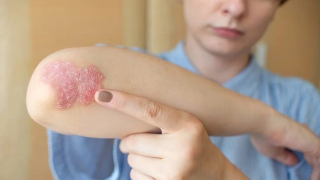आयुर्वेद के अनुसार Psoriasis क्यों होता है