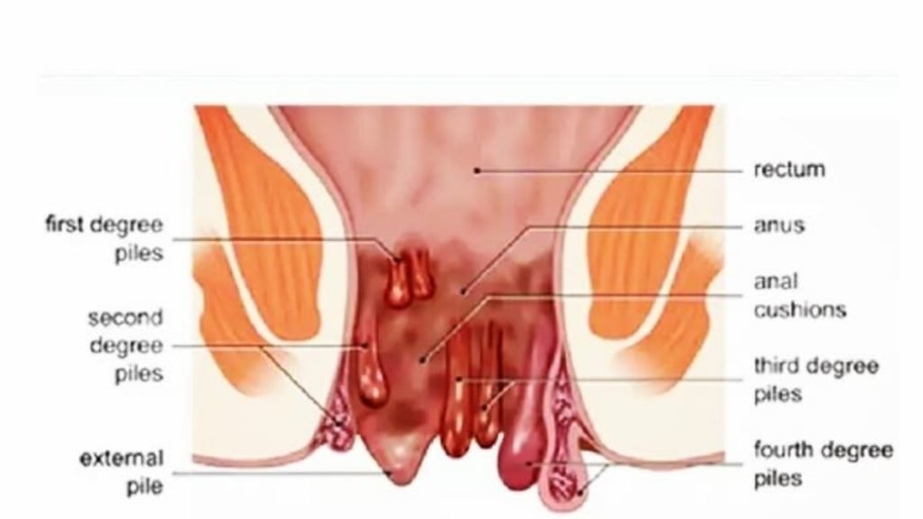 आयुर्वेद में गुदा भ्रंश का कारण