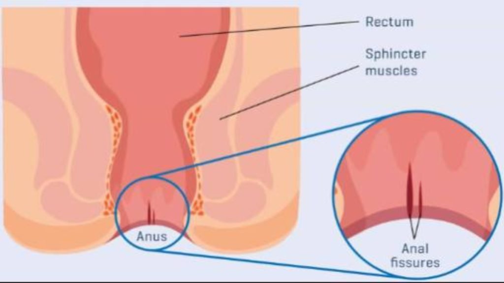 फिशर (Anal Fissure) क्या होता है?