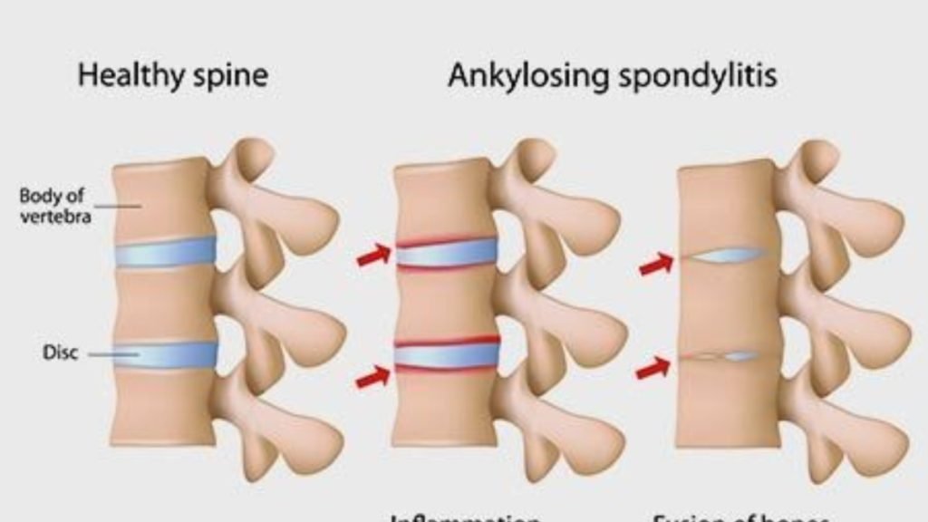 Ankylosing Spondylitis क्या है