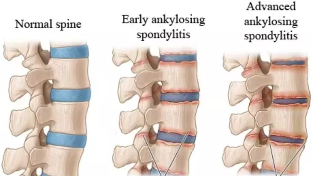 Ankylosing Spondylitis के कारण