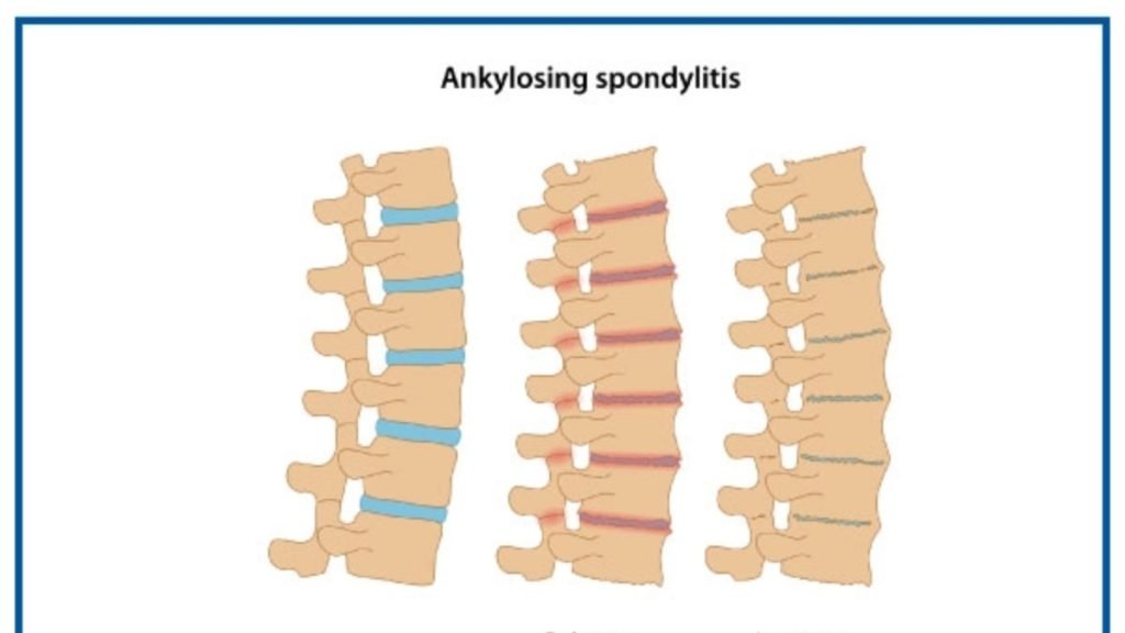 Ankylosing Spondylitis के प्रमुख लक्षण
