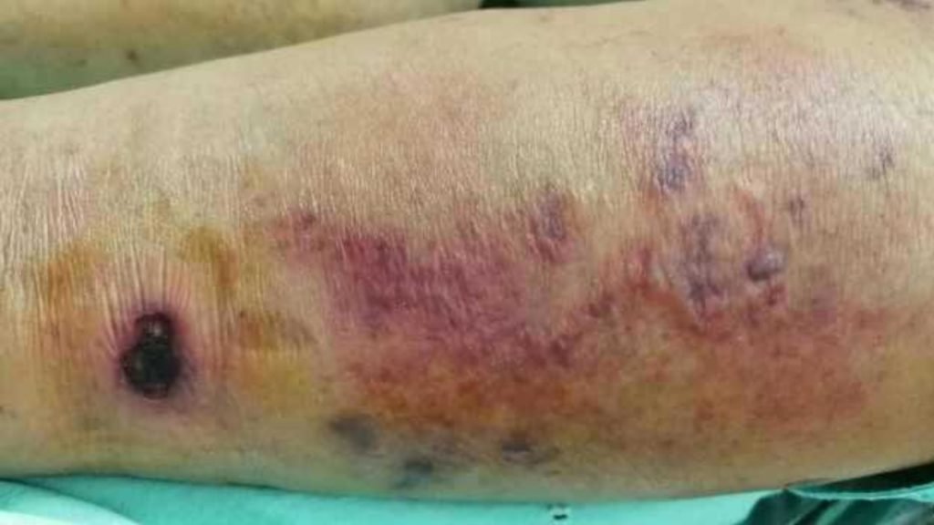 Gangrene क्या है