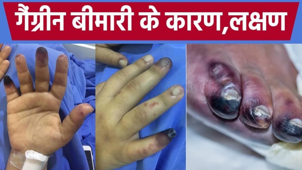 Gangrene किस कारण से होता है