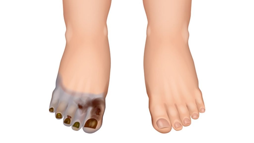 Gangrene के प्रकार