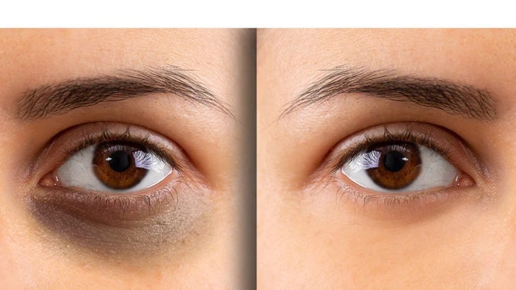 डार्क सर्कल क्या होते हैं?