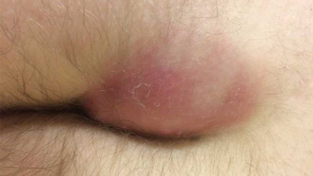 गुदा द्वार में सूजन क्या होती है