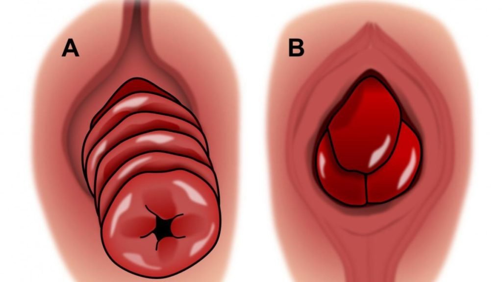 गुदा बाहर आना क्या होता है