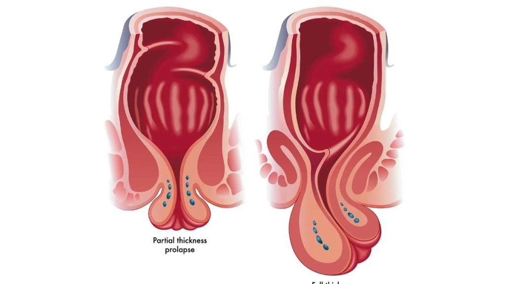 गुदा बाहर होने से हो सकती हैं ये 4 गंभीर बीमारियाँ